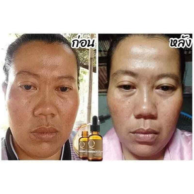 6 x Q Double Serum Reduce Wrinkles Freckles Dark Spots Aura Skin Melasma