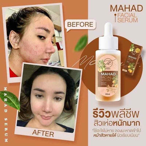 2x Mahad Facial Serum Anti-Acne Blemishes Freckles Moisturizing Soft Skin 30ml