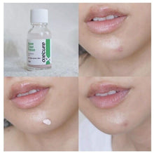 Load image into Gallery viewer, 3x Oxecure advantage acne spot Clear Potion Nourishing Sensitive Freshness Skin