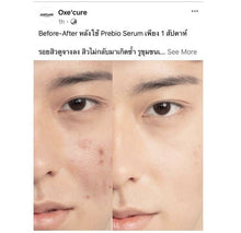 Load image into Gallery viewer, 4 Oxecure Serum Advantage Acne Spot Clear Potion Nourishing Sensitive Freshness