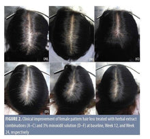 Load image into Gallery viewer, 6x Nourish Stimulate Control Regrowth Ginseng Anti Hair spray growth bottle1.5oz