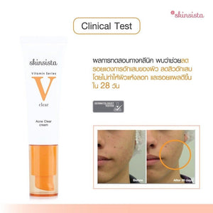 Skinsista V Acne Clear Cream Reduce Dark spots Redness Oil Control Vitamin 30ml